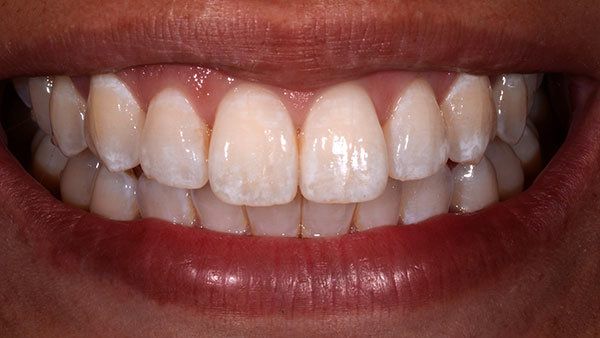 Weiße Flecken auf den Zähnen haben verschiedene Ursachen