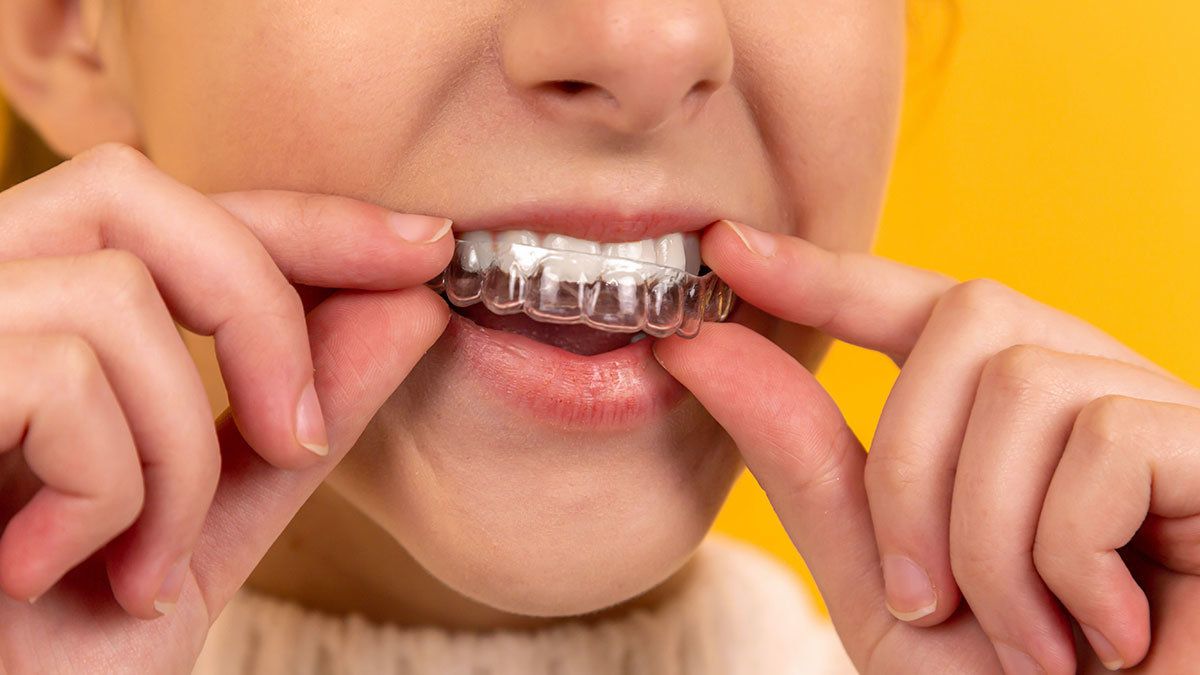 Mit einer unsichtbaren Zahnspange können schiefe Zähne und Zahnlücken ohne Einschränkungen im Alltag korrigiert werden.