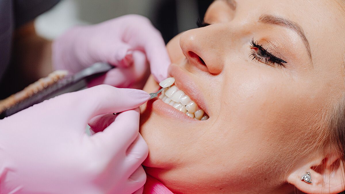 Veneers sind dünne Keramikschalen, die auf die Zähne aufgebracht werden