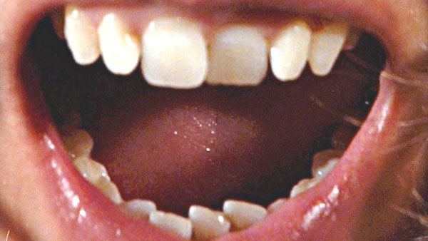 Die Zähne vor der Behandlung mit der HarmonieSchiene
