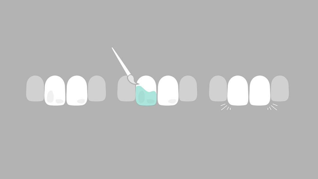 Die Entfernung von weißen Flecken auf den Zähnen mit Icon