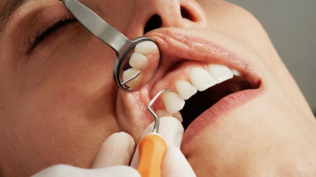 Bei einer Zahnfleischentzündung sollte schnell gehandelt werden