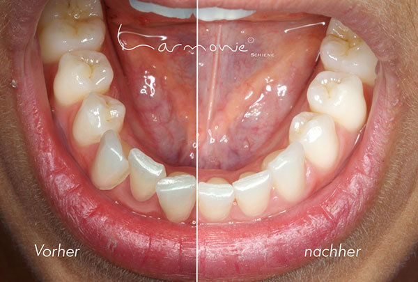 Vorher/Nachher - Behandlung mit der HarmonieSchiene